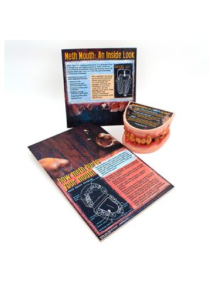 Meth Mouth: An Inside Look Display